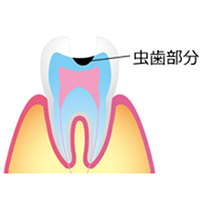 学園都市（神戸市西区）の歯医者、幸田歯科医院のむし歯治療