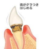 学園都市（神戸市西区）の歯医者、幸田歯科医院で歯周病治療