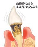学園都市（神戸市西区）の歯医者、幸田歯科医院で歯周病治療