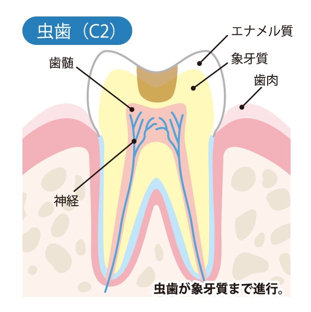 学園都市（神戸市西区）の歯医者、幸田歯科医院のむし歯治療